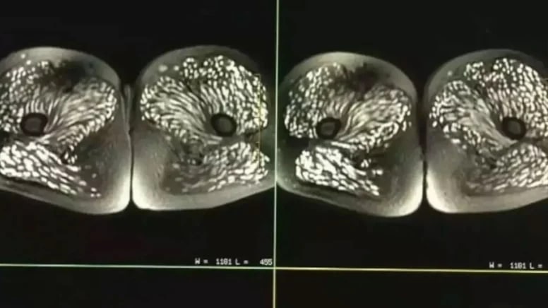 Tarama sonucunu gören doktorlar şok oldu: 10 yıl çiğ domuz eti yemiş